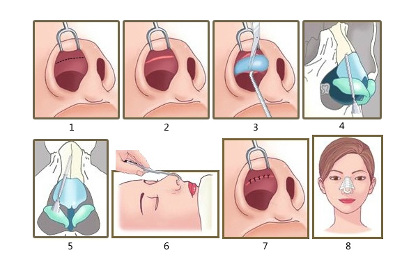 成都天使之翼隆鼻怎么樣？優(yōu)質(zhì)醫(yī)生，隆鼻案例效果反饋匯總！