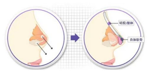 中山韓妃整形醫(yī)院做鼻子好嗎？專家口碑/案例信息點進(jìn)來了解~