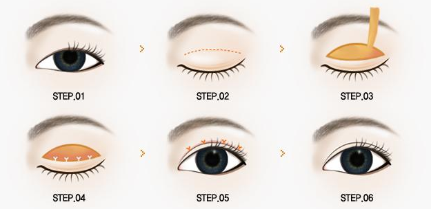 江陰中醫(yī)院美容科做雙眼皮怎么樣？6毫米平扇形雙眼皮案例效果反饋