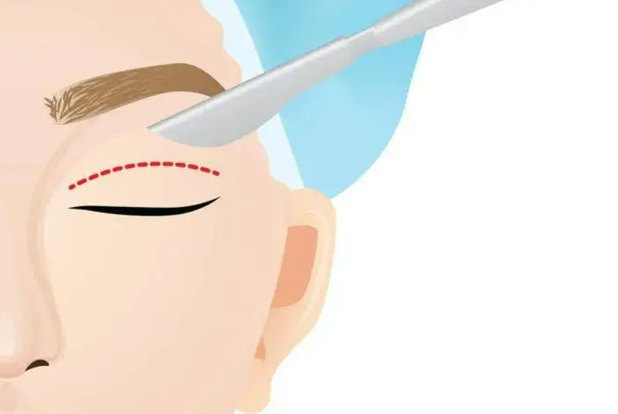 做完雙眼皮手術(shù)后如何快速消腫？小編傳授大家12個(gè)小妙招解決