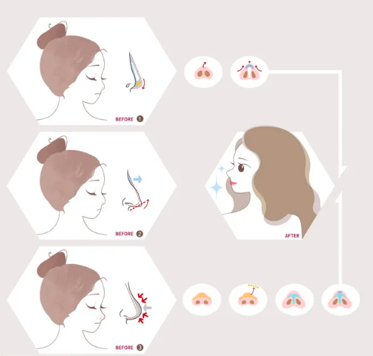 長沙臉博士做鼻子評價如何？優(yōu)質醫(yī)生推薦,隆鼻效果展示