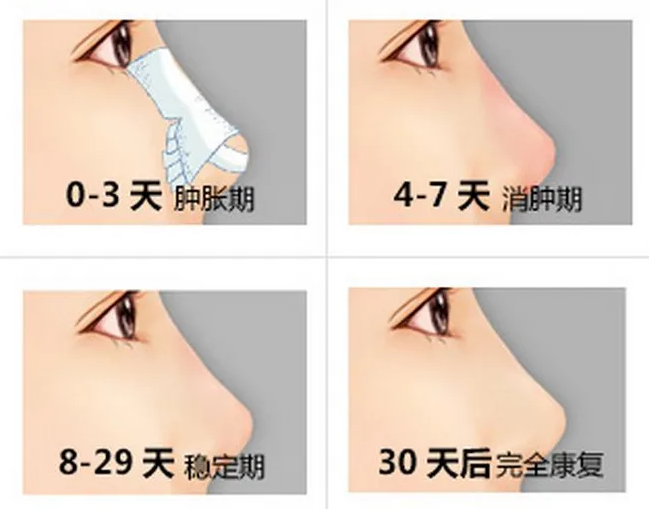 濱醫(yī)附院整形科隆鼻真人案例分享，內(nèi)附醫(yī)院信息