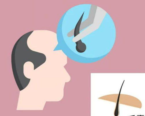 頭發(fā)移植后是否仍會(huì)脫落？詳細(xì)介紹一覽