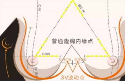 駐馬店中心醫(yī)院隆胸多少錢(qián)？收費(fèi)標(biāo)準(zhǔn)參考+項(xiàng)目術(shù)后感受