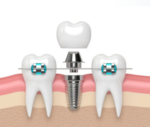 連云港口腔醫(yī)院牙齒種植技術怎樣？價格表資料及詳細案例信息