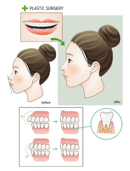 金屬托槽矯正是什么？
