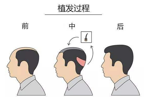 中山植發(fā)手術(shù)需要多少錢?頭發(fā)種植醫(yī)生綜合實(shí)力前3介紹