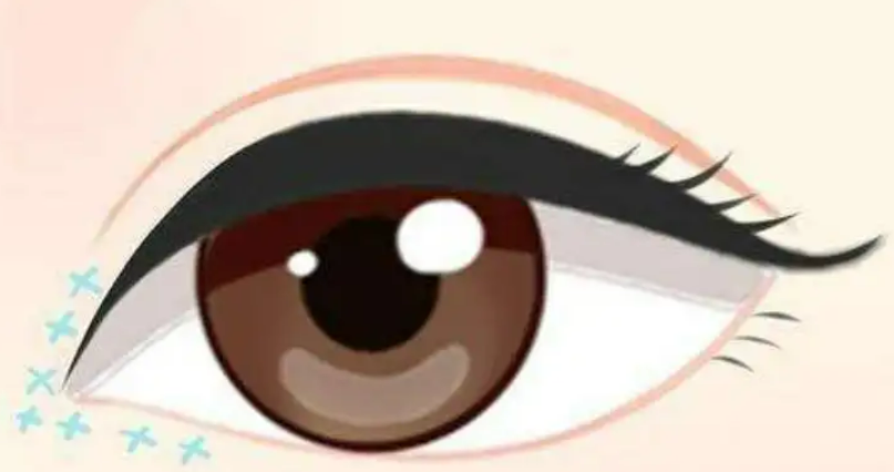 割雙眼皮后眼皮耷拉及增生了怎么辦？解決秘籍告訴你