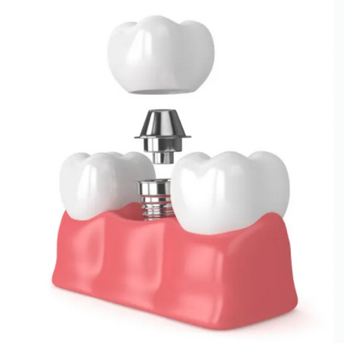 北京航空總醫(yī)院口腔科種植牙價格是多少？內(nèi)含種植牙案例