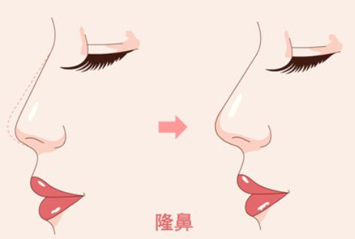 廣州美恩整形醫(yī)院隆鼻多少錢(qián)？醫(yī)院簡(jiǎn)介|術(shù)后反饋