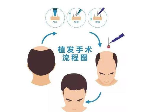 廣州碧蓮盛植發(fā)醫(yī)院怎么樣?費(fèi)用參考及頭發(fā)種植案例