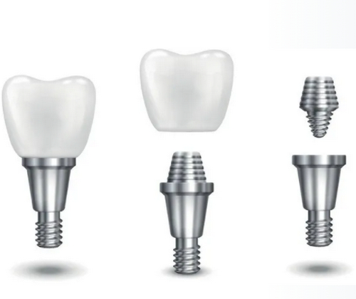 溫州醫(yī)科大學(xué)附屬第二醫(yī)院口腔科牙齒種植收費(fèi)怎樣？醫(yī)院機(jī)構(gòu)背景資料+案例信息
