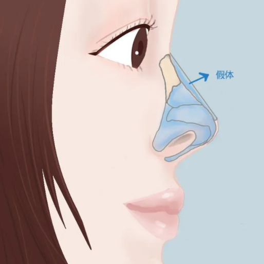 張家口尚美醫(yī)院整形科隆鼻多少錢？案例效果+醫(yī)院簡介