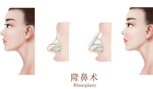 廣州曙光醫(yī)學美容醫(yī)院隆鼻多少錢，醫(yī)院真實隆鼻案例與價格來襲！