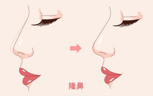 武漢協(xié)和醫(yī)院整形外科隆鼻多少錢？醫(yī)院案例信息匯總