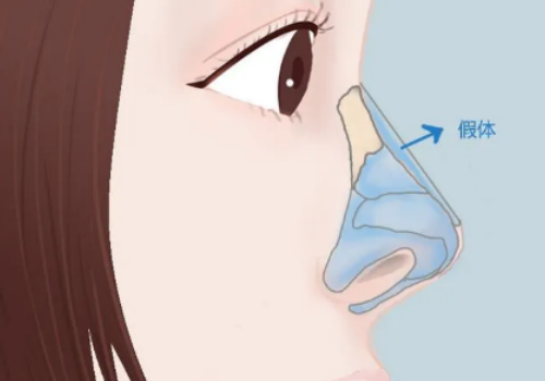 北京晶美整形醫(yī)院隆鼻怎么樣？術后果反饋及費用