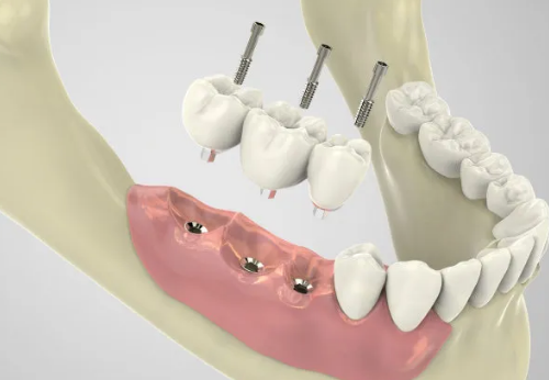 天津市口腔醫(yī)院種植牙多少錢一顆？案例反饋|收費(fèi)參考