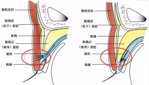 南寧美麗焦點(diǎn)美容醫(yī)院評價(jià)好嗎？雙眼皮案例及收費(fèi)標(biāo)準(zhǔn)參考