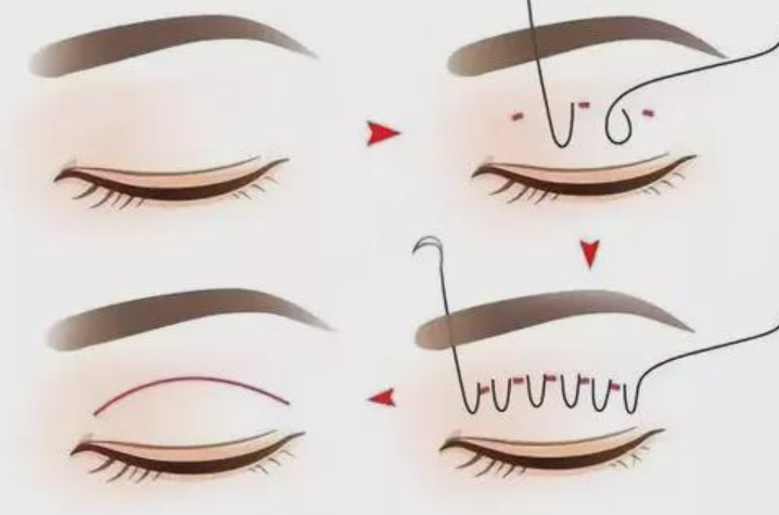 蘇州大學(xué)附屬第二醫(yī)院整形科雙眼皮怎么樣？實力醫(yī)院推薦