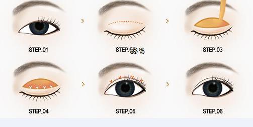 泉州海峽醫(yī)療美容醫(yī)院雙眼皮多少錢？術(shù)后小貼士&案例口碑