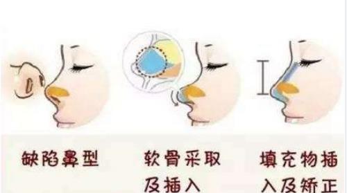 南陽薇美醫(yī)療整形醫(yī)院隆鼻價格|醫(yī)院信息及案例口碑細節(jié)展示