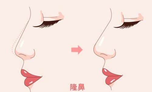 濟南諾德醫(yī)院隆鼻怎么樣？案例反饋及費用標準發(fā)布