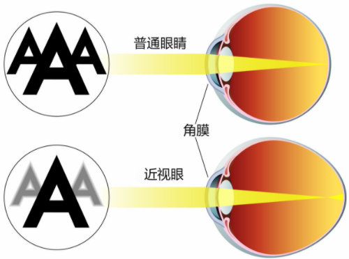 貴州晶朗眼科醫(yī)院眼科怎么樣？近視手術案例分享+相關問答