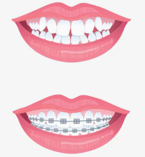 時代天使隱形矯正牙齒的價格高嗎？