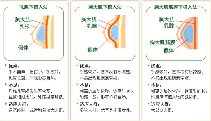 法芮婭和傲諾拉的區(qū)別在哪里？假體隆胸案例反饋：重回少女酥胸
