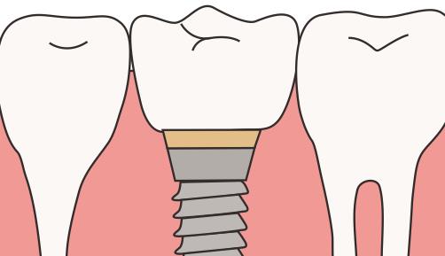 吉林大學口腔醫(yī)院收費標準|牙齒種植案例和醫(yī)院介紹