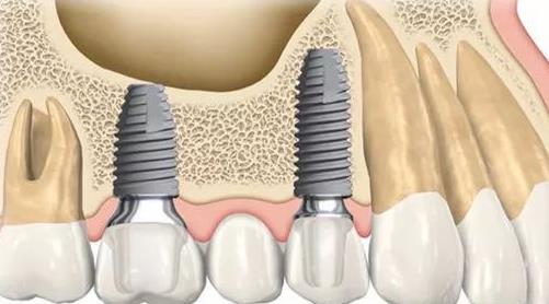 南京醫(yī)科大學(xué)附屬口腔醫(yī)院補(bǔ)牙要多少錢(qián)？醫(yī)院口碑及案例一覽