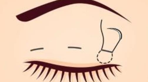 昆明醫(yī)科大學(xué)第二附屬醫(yī)院雙眼皮修復(fù)多少錢？項(xiàng)目案例參考