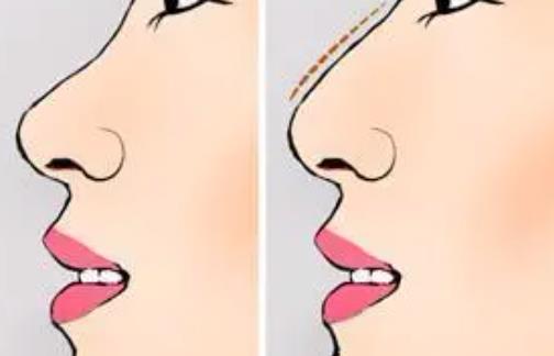 重慶市南岸區(qū)中西醫(yī)結(jié)合醫(yī)院隆鼻多少錢？收費(fèi)標(biāo)準(zhǔn)|案例反饋