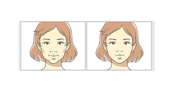 武漢協(xié)和醫(yī)院整形美容科怎么樣？自體脂肪填充真人案例術后效果公開