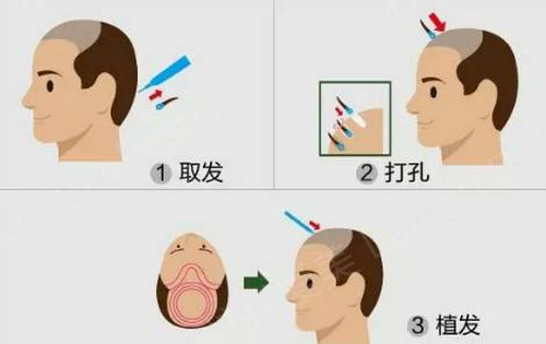 北京協(xié)和醫(yī)院植發(fā)科怎么樣？?jī)r(jià)格表及坐診專(zhuān)家醫(yī)生簡(jiǎn)介一覽