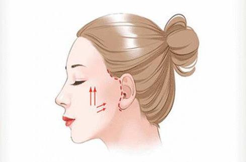 濟(jì)寧人民醫(yī)院整形科怎么樣？?jī)?nèi)附玻尿酸注射抗衰真人案例