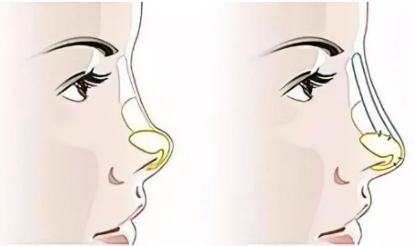 西安交大一附院美容整形科隆鼻手術(shù)費用，口碑評價&醫(yī)院信息詳情