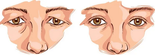 廈門薇格做眼睛可以嗎？醫(yī)生技術(shù)好收費合理，附雙眼皮案例