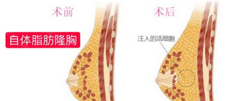 鄭州辰星整形醫(yī)院隆胸多少錢？實力醫(yī)生上線，隆胸案例分享