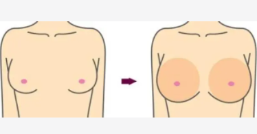 隆胸6.png 隆胸6.png