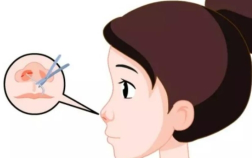 枝江諾美醫(yī)療美容診所假體隆鼻多少錢？附案例分享