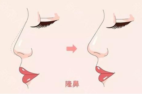 許昌市整形科假體隆鼻多少錢？口碑評價展示