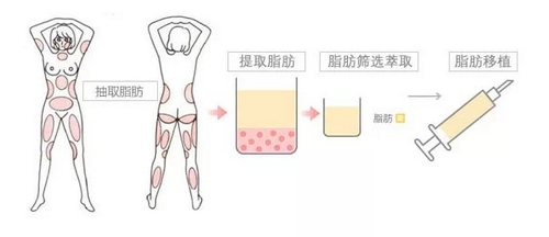 成都美立方醫(yī)療美容醫(yī)院抽脂正規(guī)嗎？醫(yī)院信息+技術(shù)優(yōu)勢查看