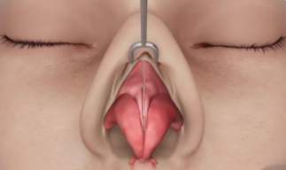 隆鼻15.png 隆鼻15.png