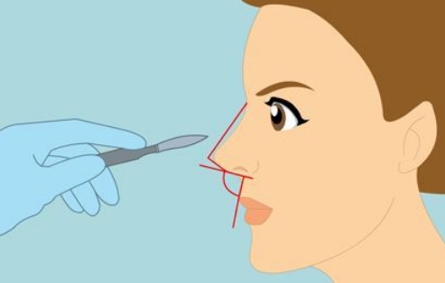 鄂州市整形科隆鼻多少錢？過程記錄