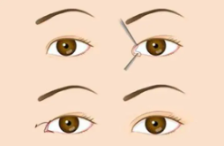 雙眼皮18 (2).png 雙眼皮18 (2).png