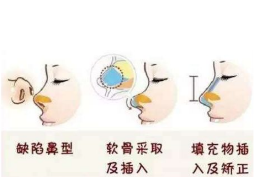 衢州市中醫(yī)院整形美容燒傷科隆鼻怎么做好護理，手術(shù)后可以吃辣嗎？
