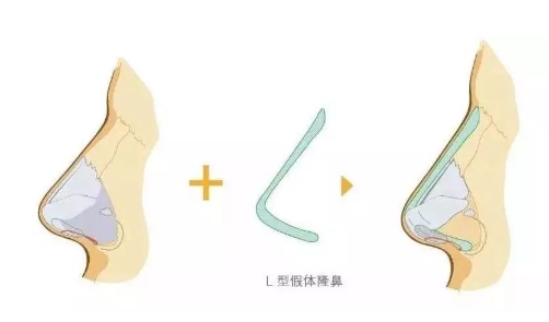 廣東畫美醫(yī)療美容整形醫(yī)院隆鼻多少錢？哪個(gè)醫(yī)生技術(shù)強(qiáng)