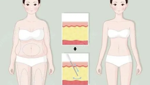 共振吸脂瘦大腿有害處嗎