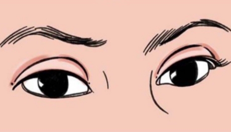 商丘市中心醫(yī)院整形科雙眼皮價格？雙眼皮案例參考